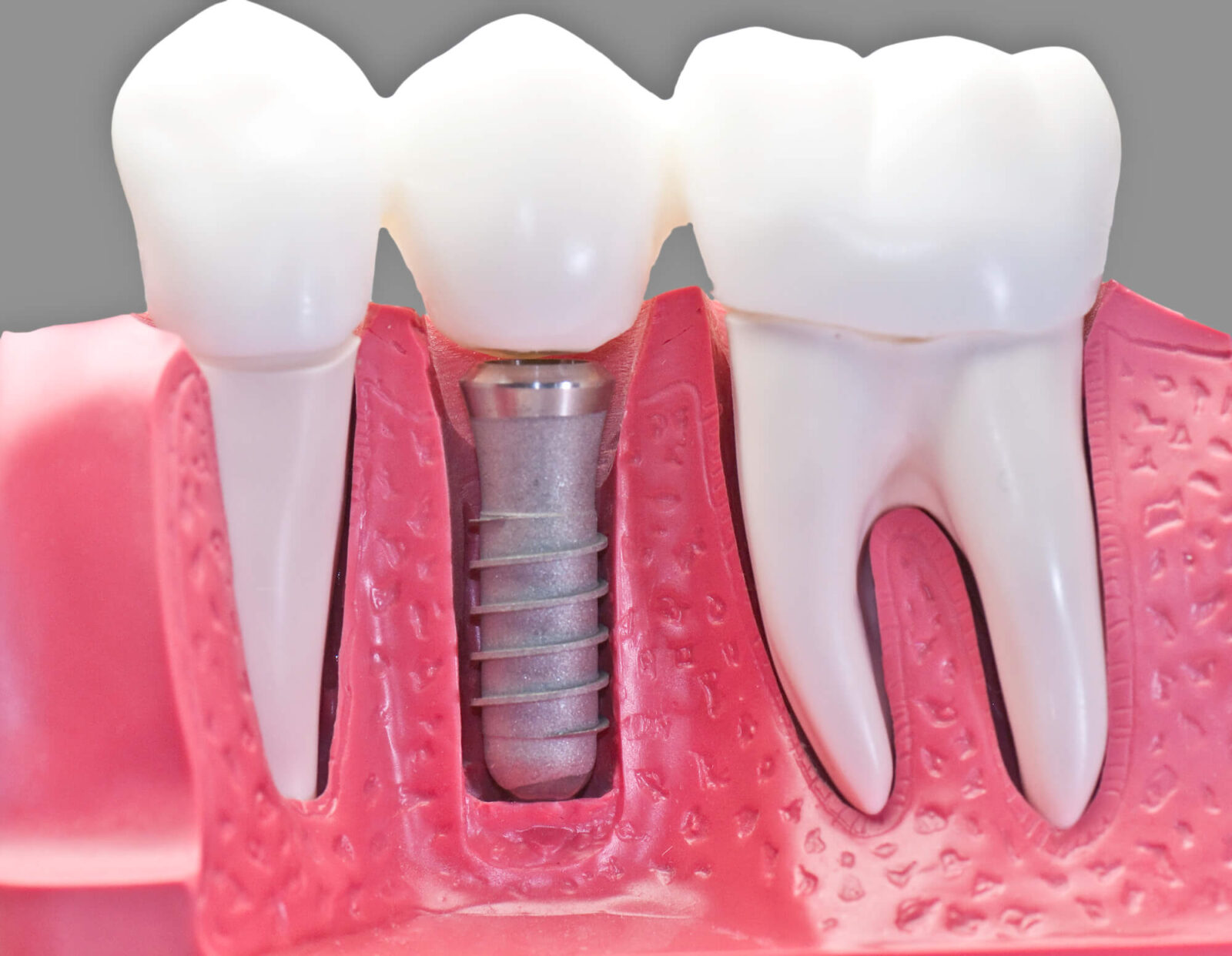 3D model of dental implants in coral springs fl