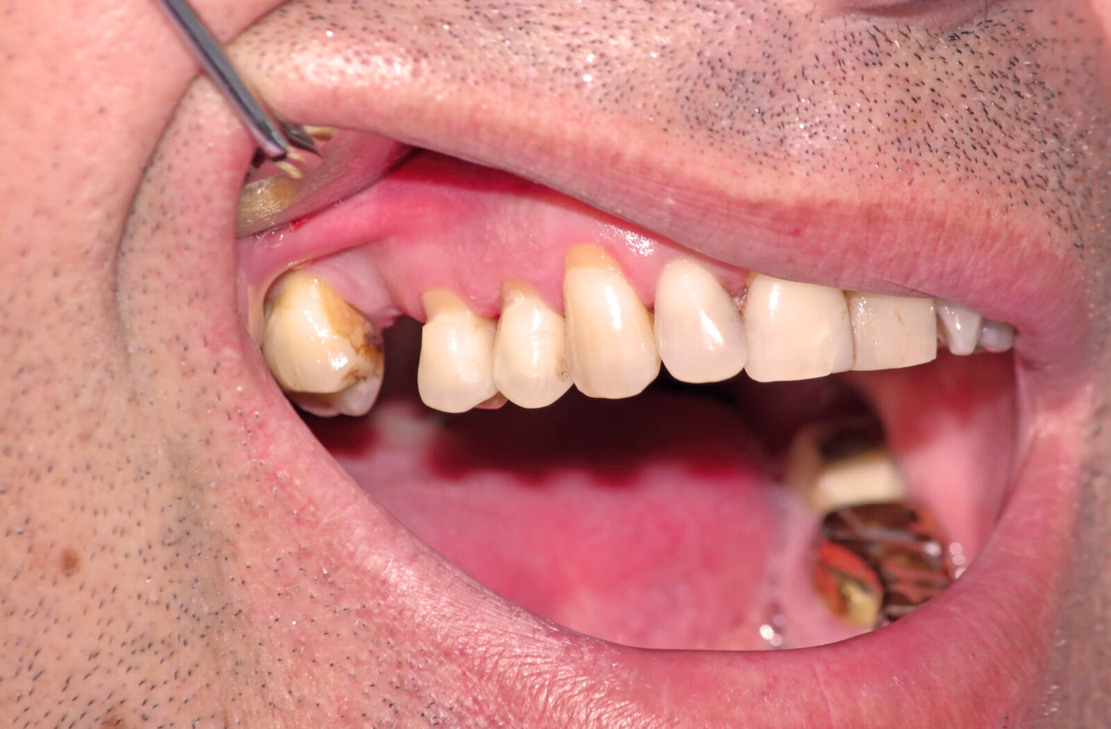 dentist in Coral Springs just extracted a tooth