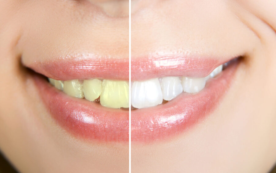 smile before and after teeth whitening in coral springs